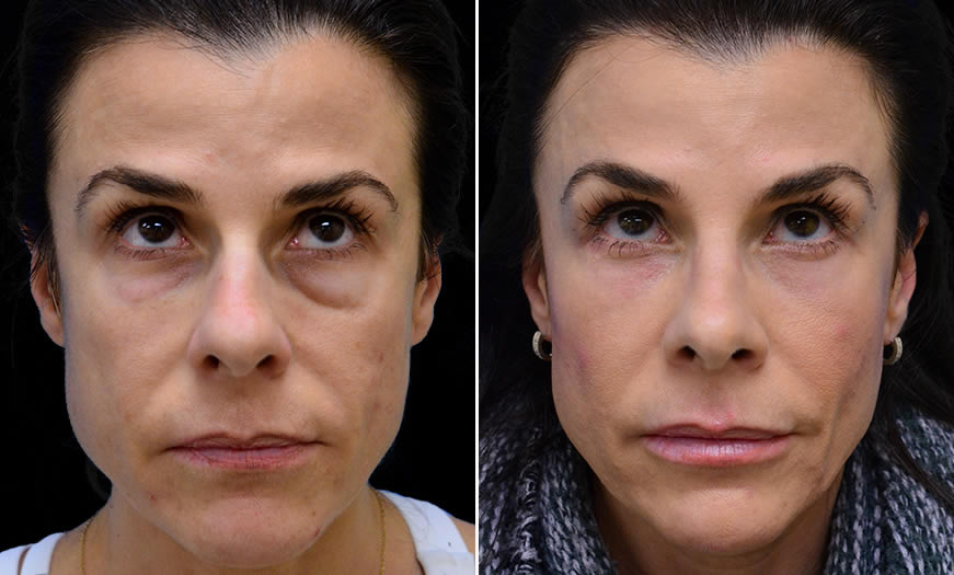 Before & After Rhinoplasty Front View 2