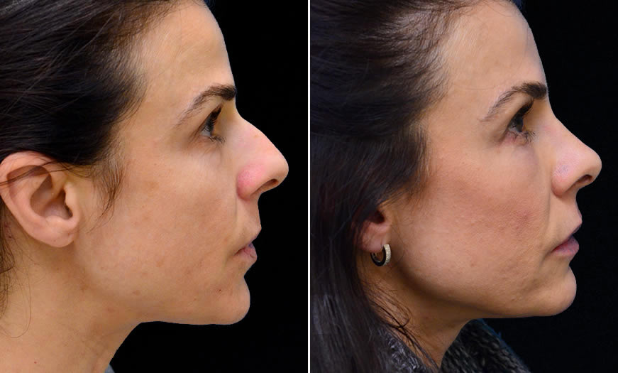 Before & After Rhinoplasty Side Right View