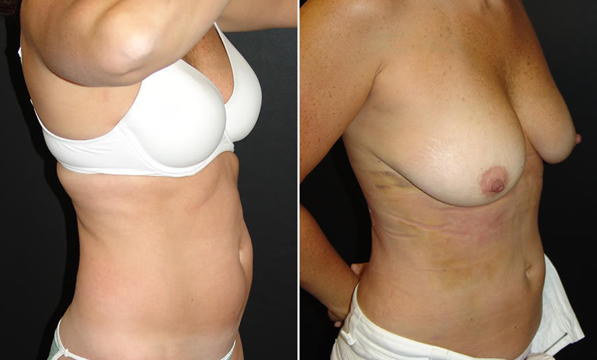 Before & After Liposuction Quarter Right View