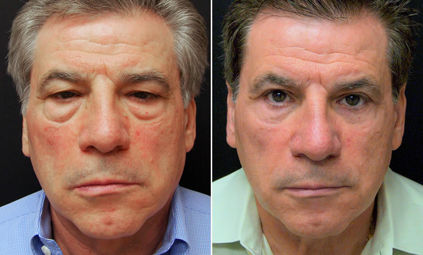 Before And After Festoon Surgery In NJ