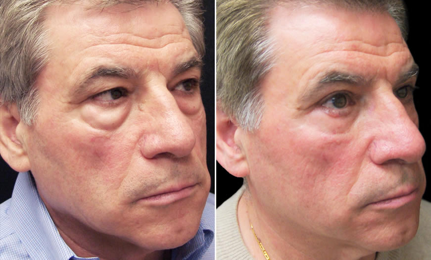 Festoon Surgery Before & After In NJ