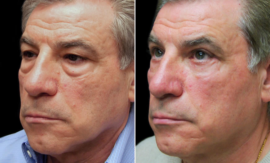 Before & After Festoon Surgery In NJ