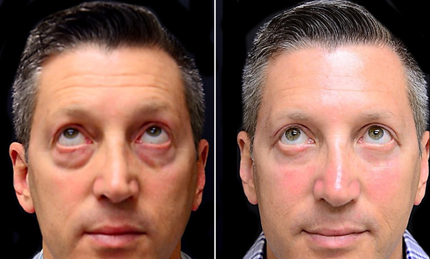 Festoon Surgery Before And After In New Jersey