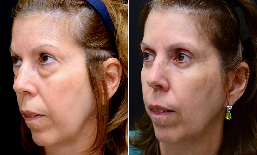 Festoon Treatment Before And After In New Jersey