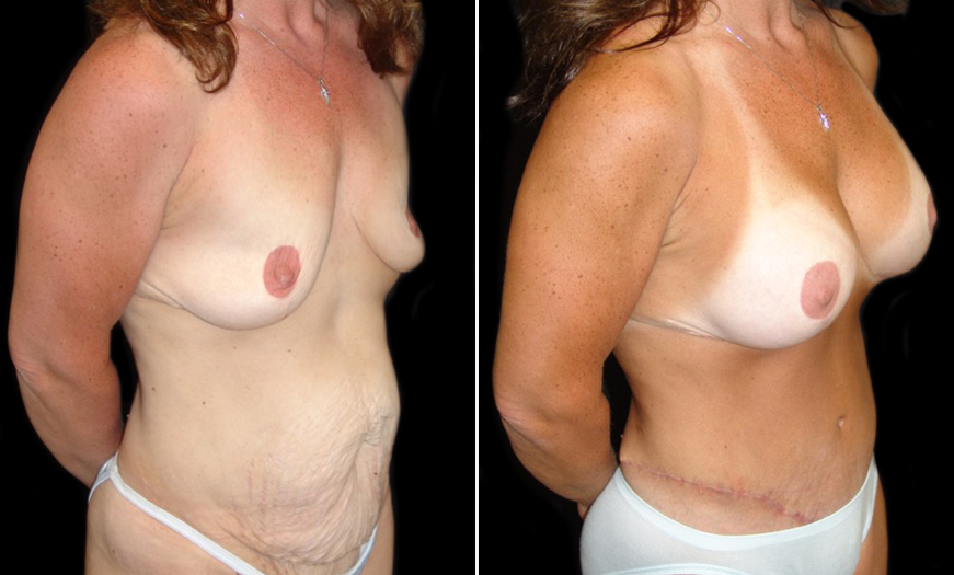 CORE Abdominoplasty In NJ Before And After