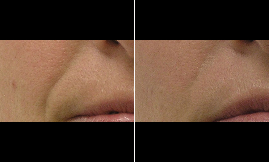 Before And After HydraFacial MD® Treatment