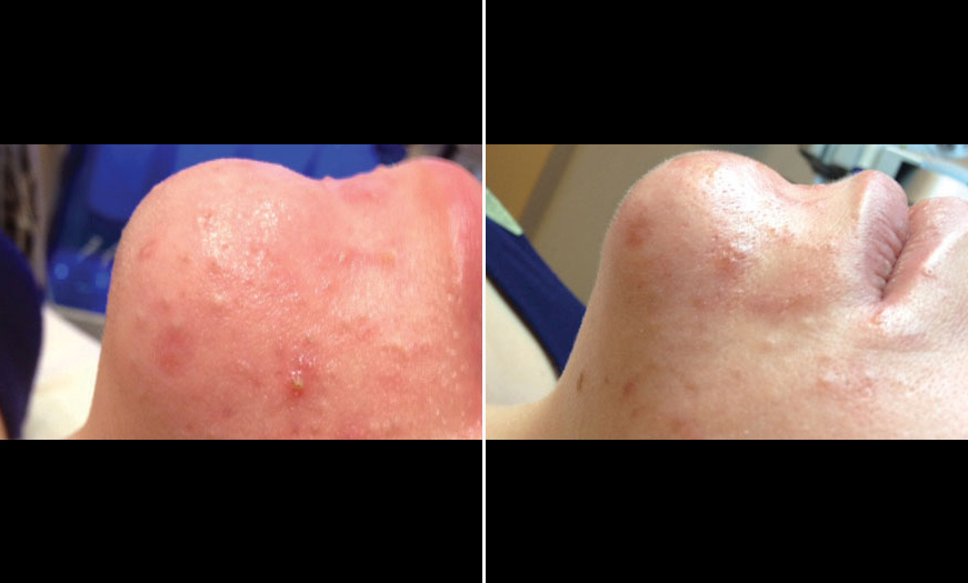 Before & After HydraFacial MD® Treatment