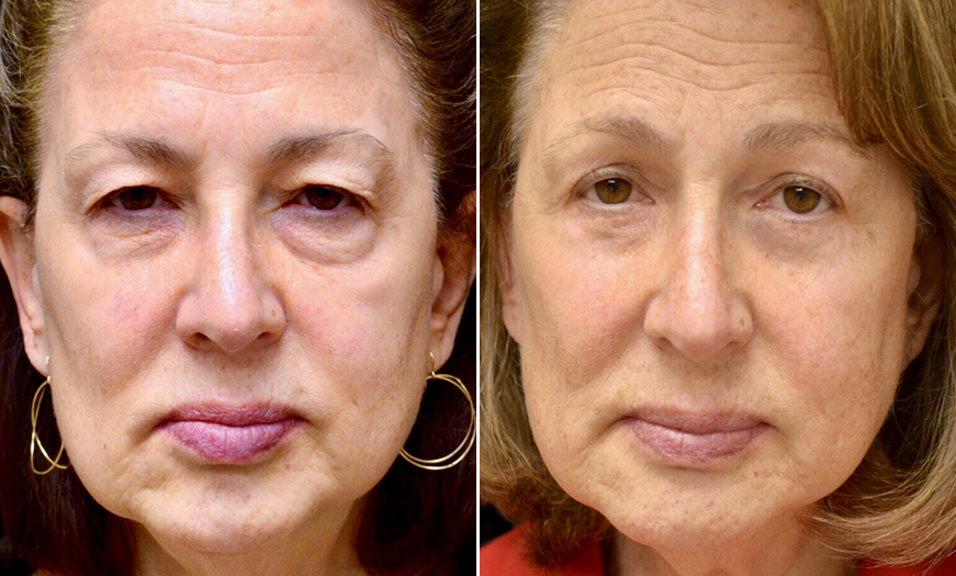 NJ Blepharoplasty Before & After