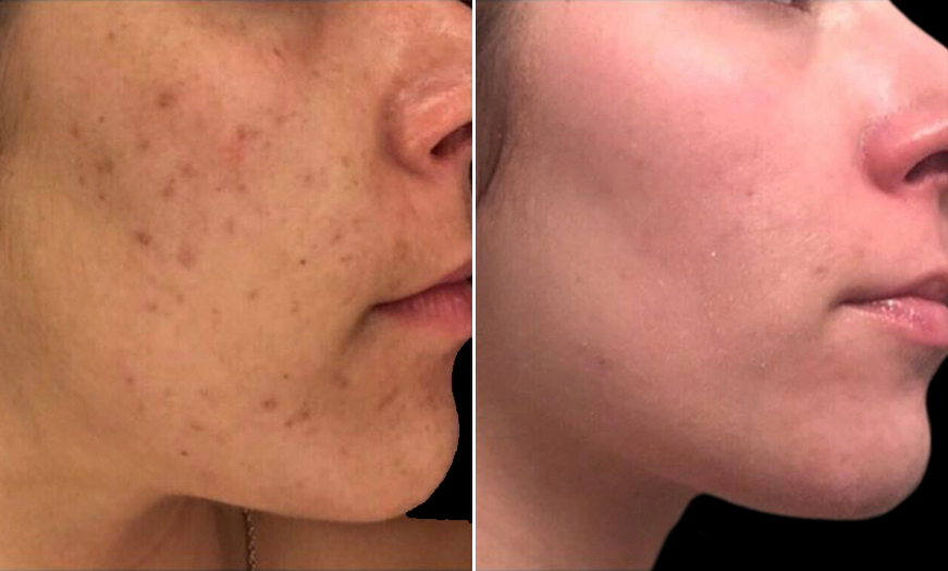 Microneedling Before And After