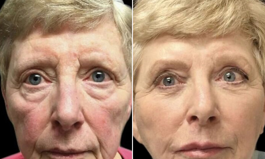 NJ Blepharoplasty Before And After