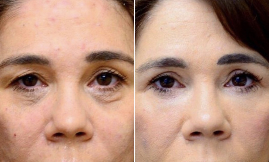 NJ Blepharoplasty Results