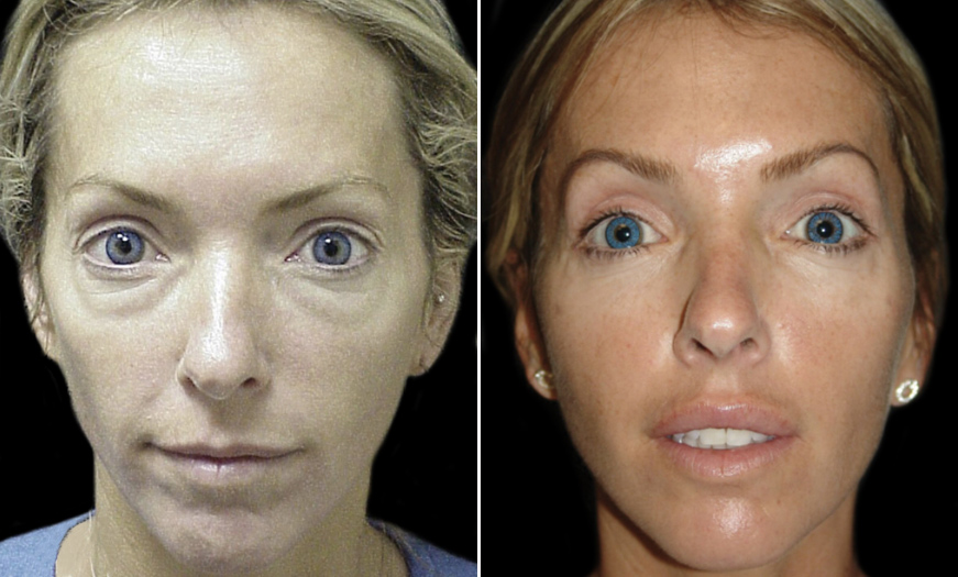 Before And After Blepharoplasty In NJ