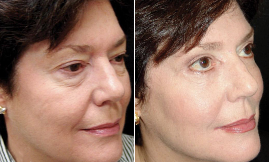 Before & After Blepharoplasty In NJ