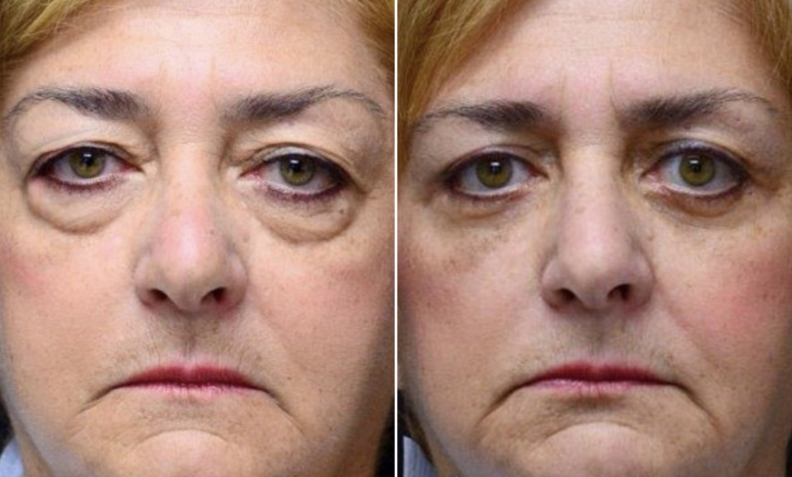 New Jersey Blepharoplasty Before And After