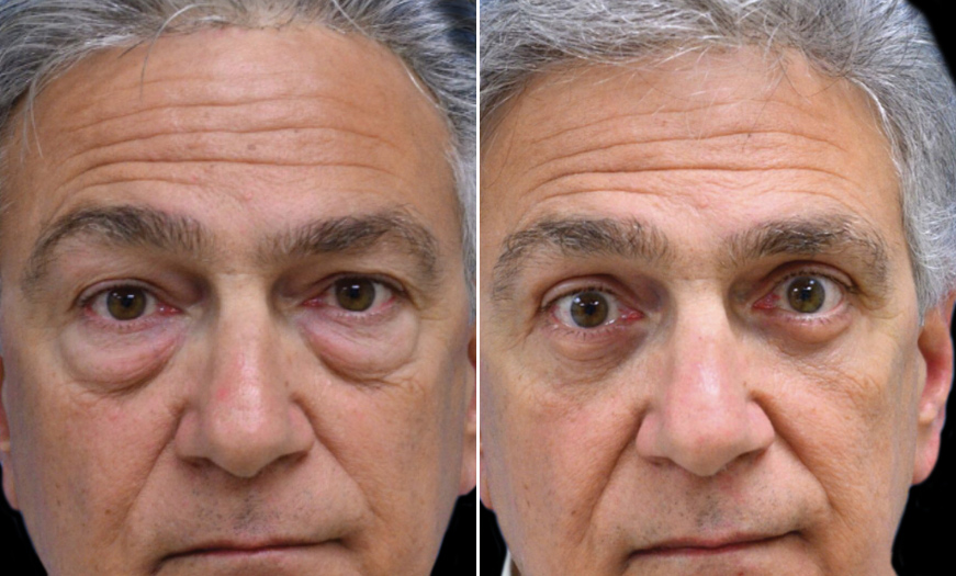 New Jersey Blepharoplasty Before & After