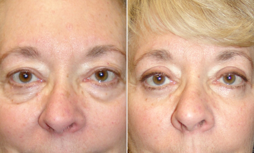 New Jersey Blepharoplasty Results