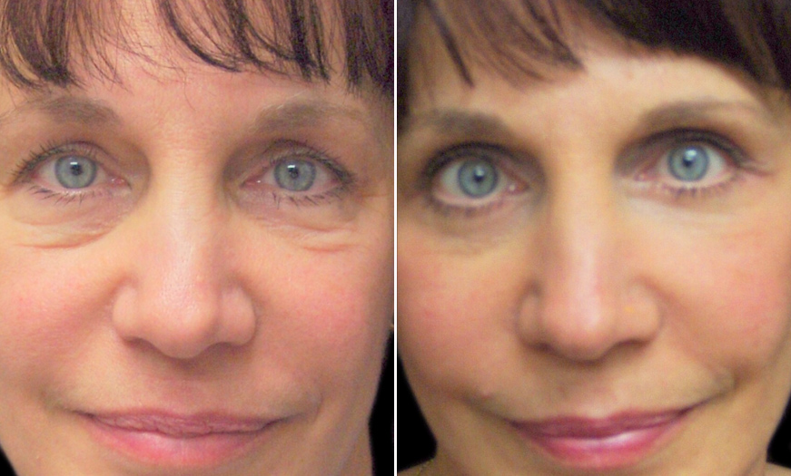 Before And After Blepharoplasty In New Jersey