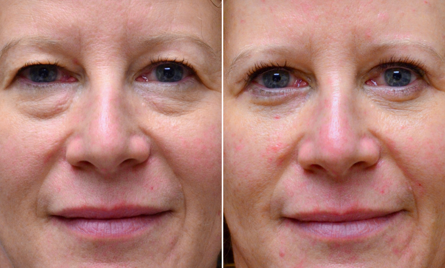 Before & After Blepharoplasty In New Jersey