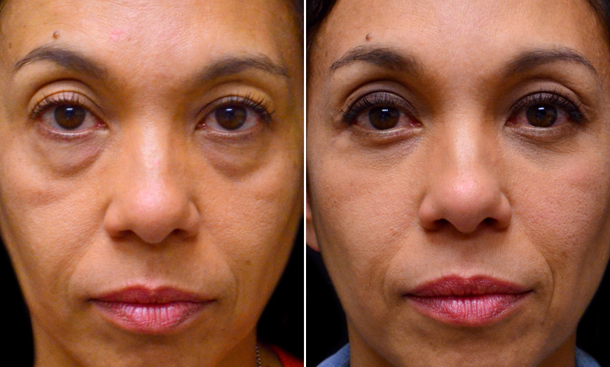 NJ Blepharoplasty Surgery Before And After