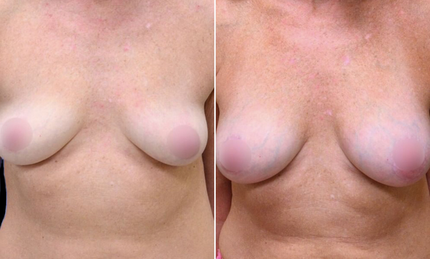 NJ Breast Augmentation Before And After