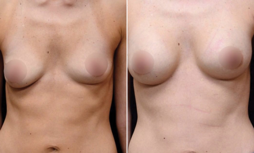 NJ Breast Augmentation Before & After