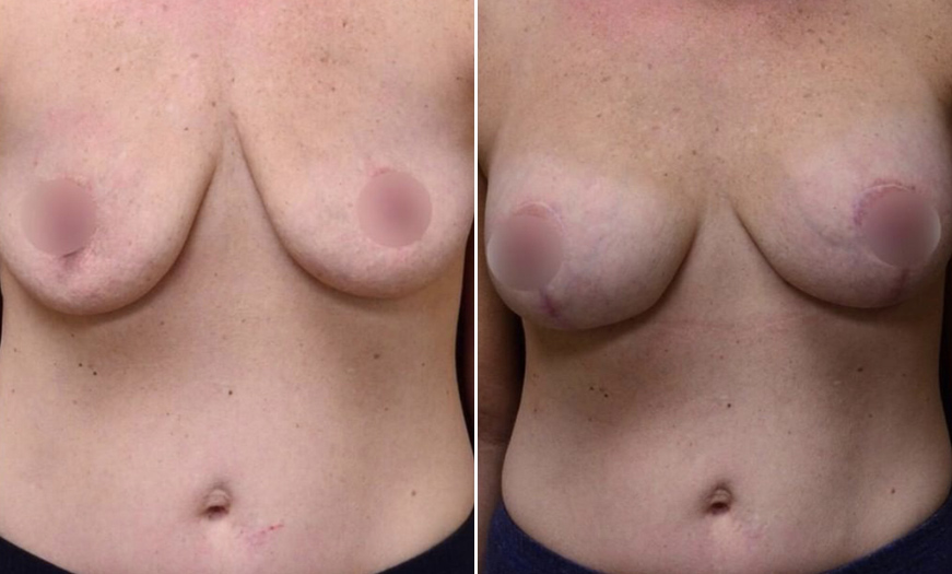 NJ Breast Augmentation Results