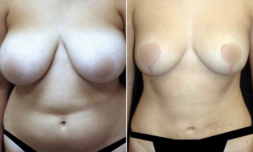 NJ Breast Lift Before And After