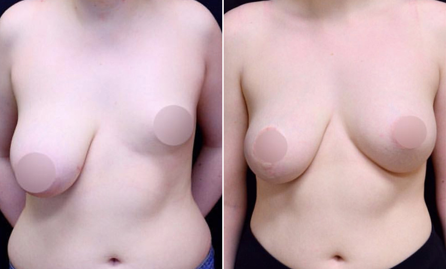 NJ Breast Reduction Results