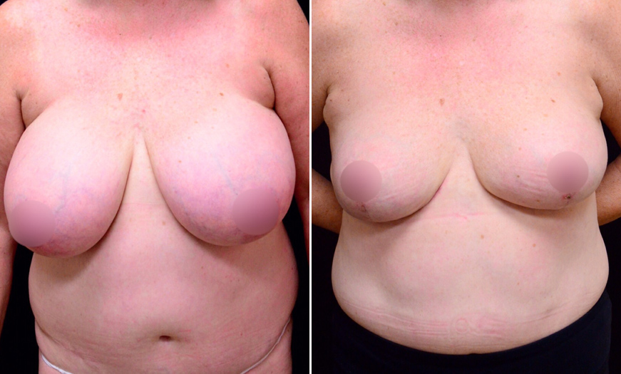 Before And After Breast Reduction In NJ