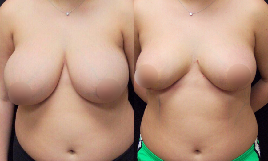 Before & After Breast Reduction In NJ