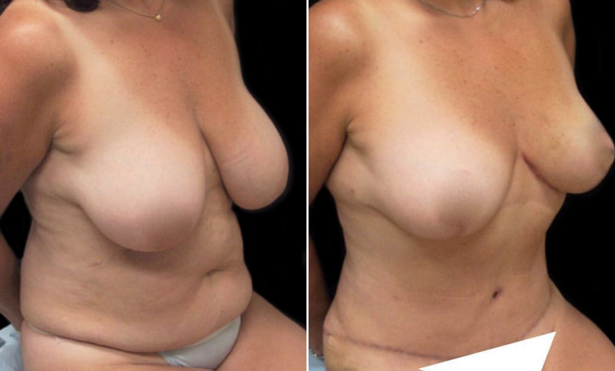 New Jersey Breast Reduction Before & After