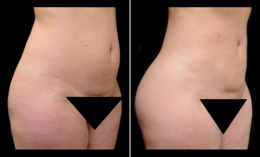 Fat Grafting Before And After