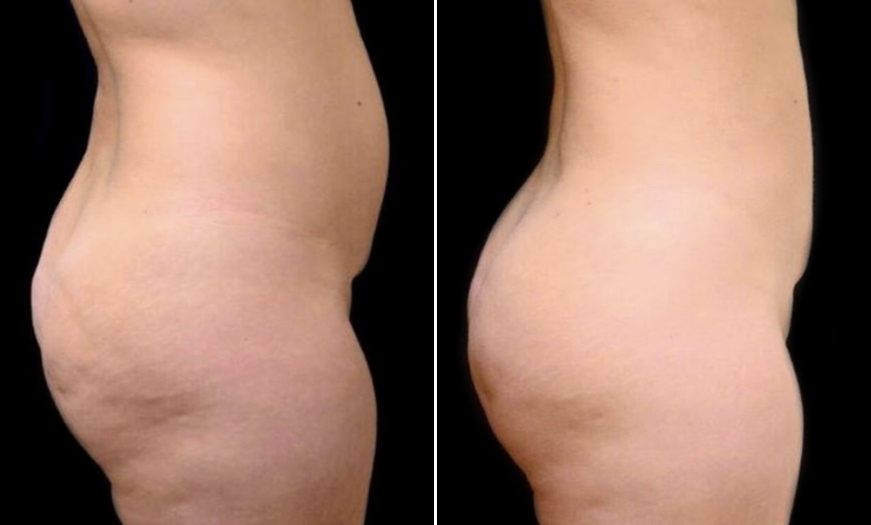 Fat Grafting Before & After