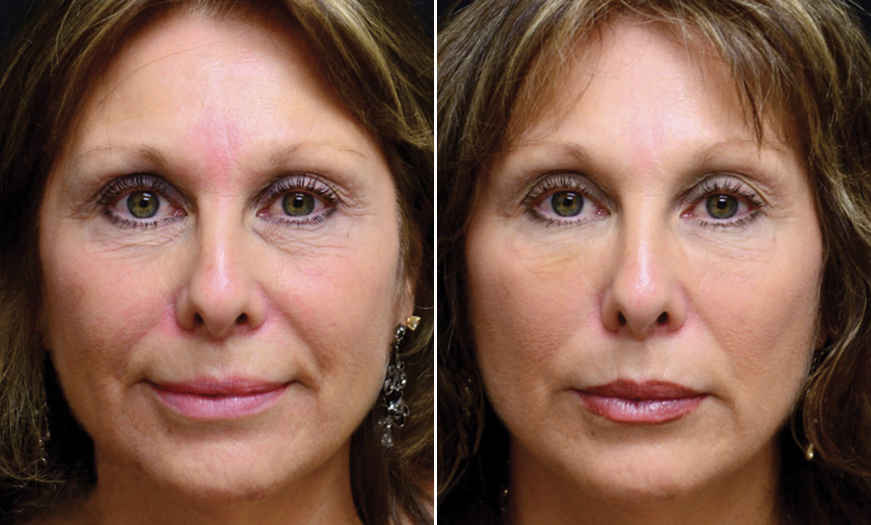 Cosmetic Injections Results