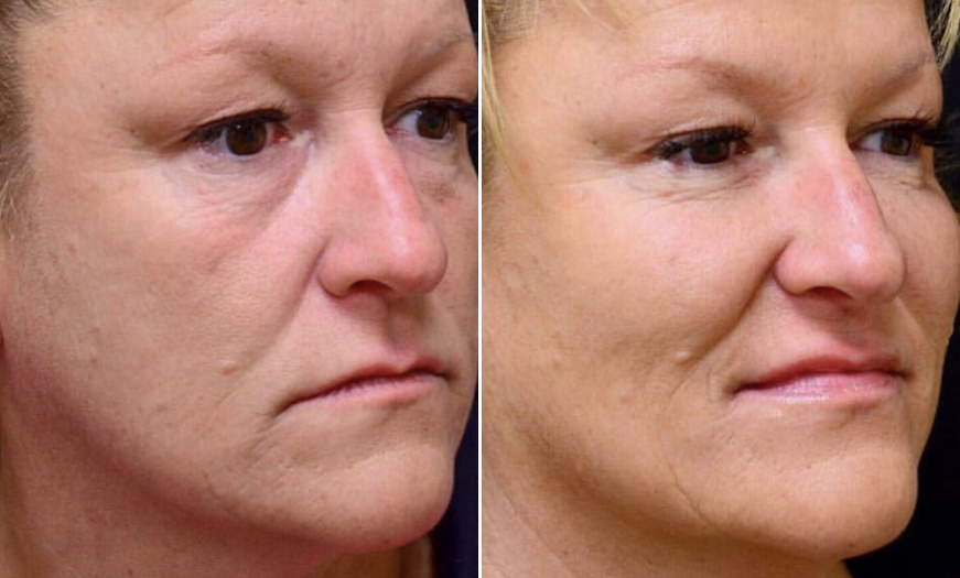 Before And After Dermal Fillers