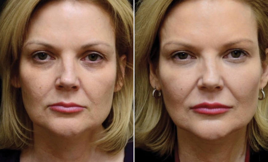 Before & After Dermal Fillers