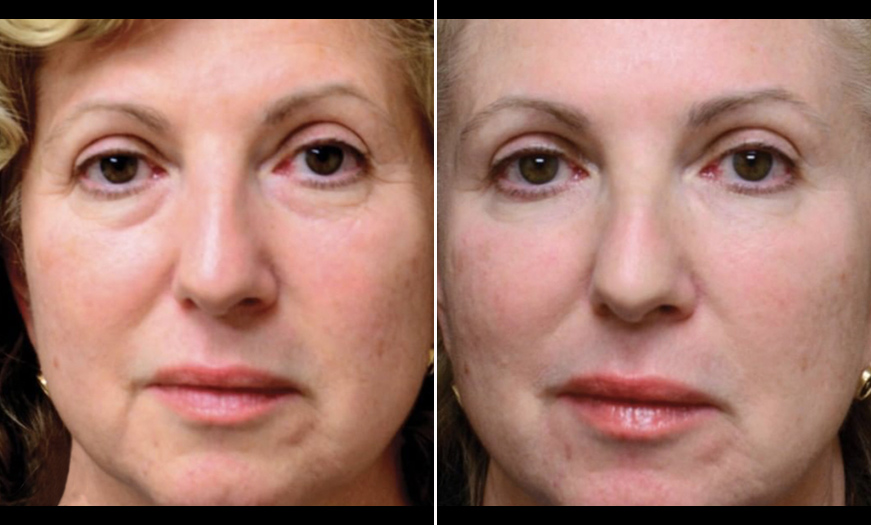 Dermal Fillers Results