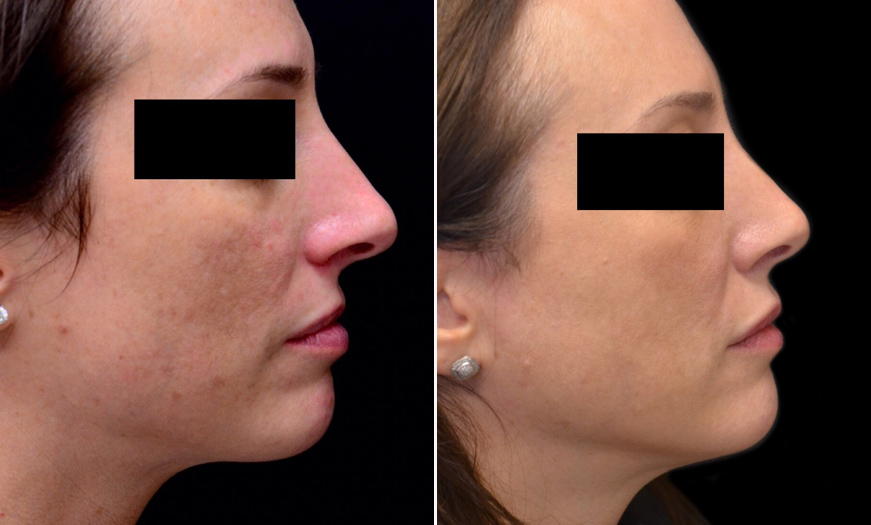 NJ Rhinoplasty Before And After