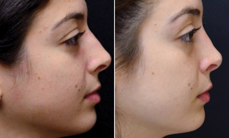 NJ Rhinoplasty Before & After