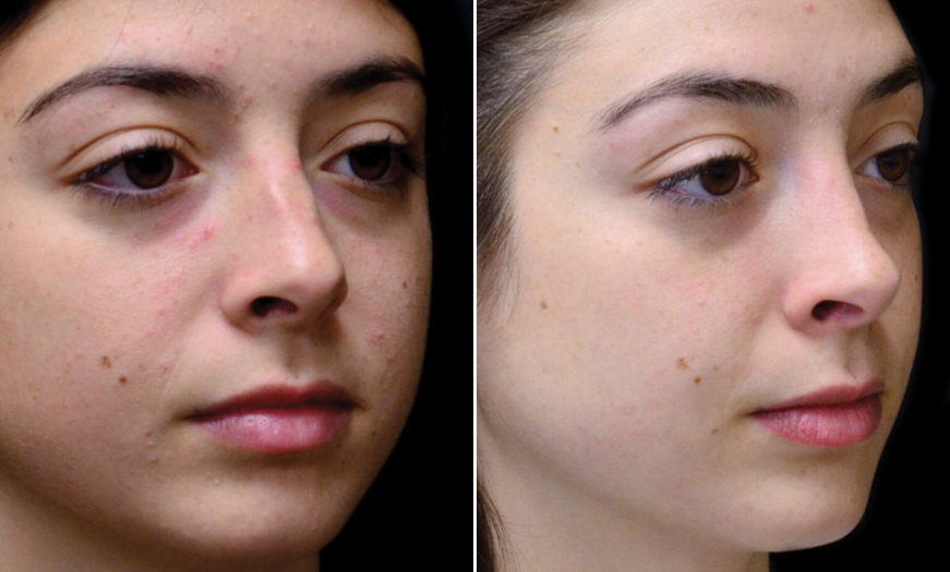 NJ Rhinoplasty Results