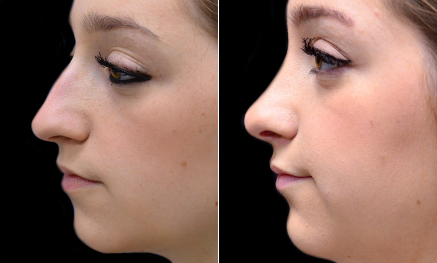 Before & After Rhinoplasty In NJ