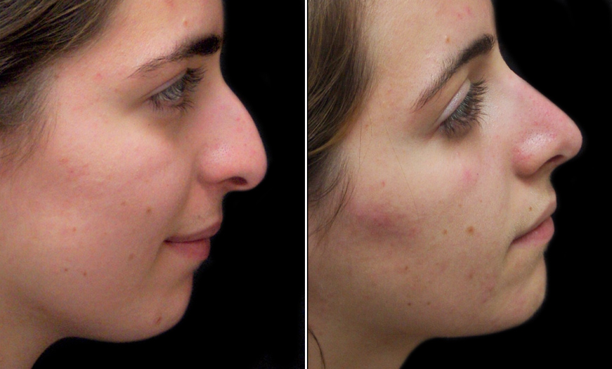 New Jersey Rhinoplasty Before And After