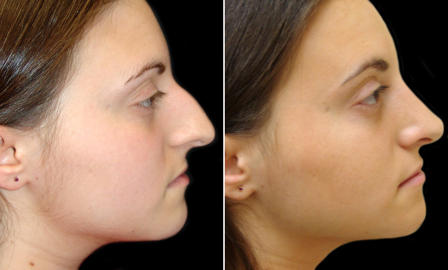 New Jersey Rhinoplasty Before & After