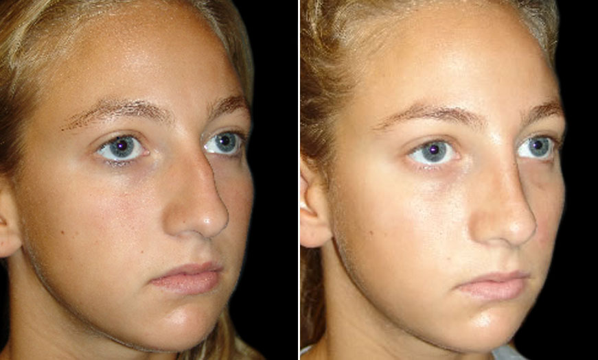 Before & After Rhinoplasty Quarter Right View