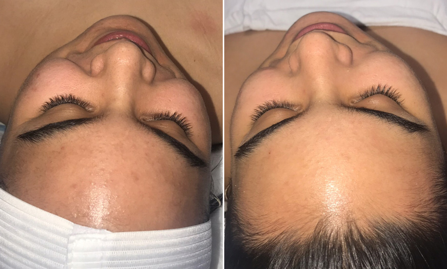 Before And After HydraFacial Treatment