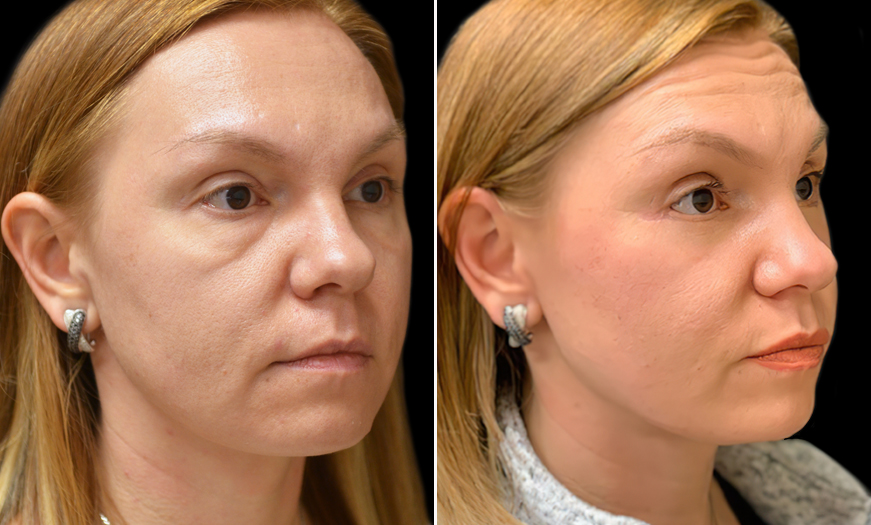 Blepharoplasty Before & After