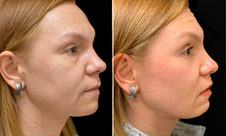 Before and After Blepharoplasty 