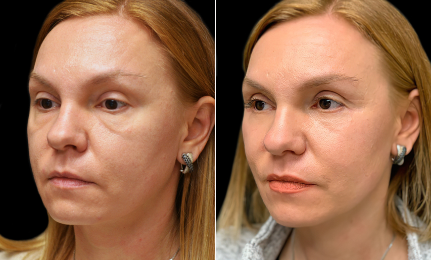 Before & After Blepharoplasty