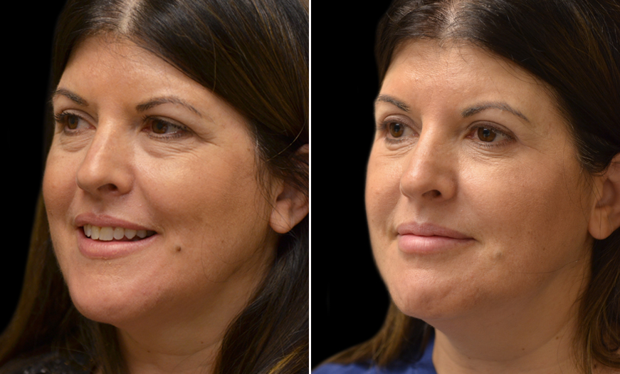 Before and After Blepharoplasty Surgery