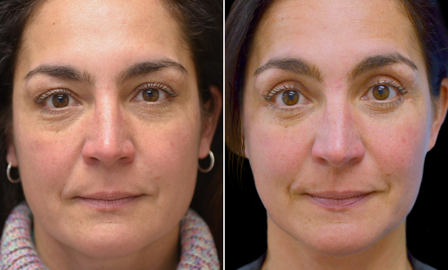 Before & After Blepharoplasty Surgery